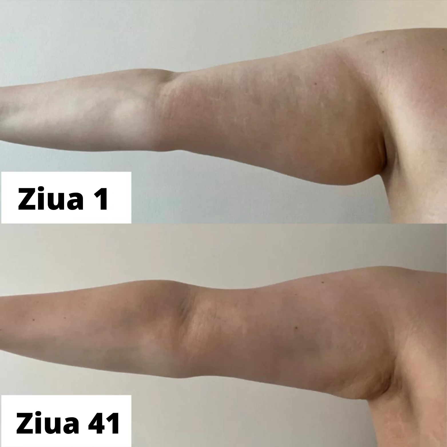 Celulită Ulei de masaj