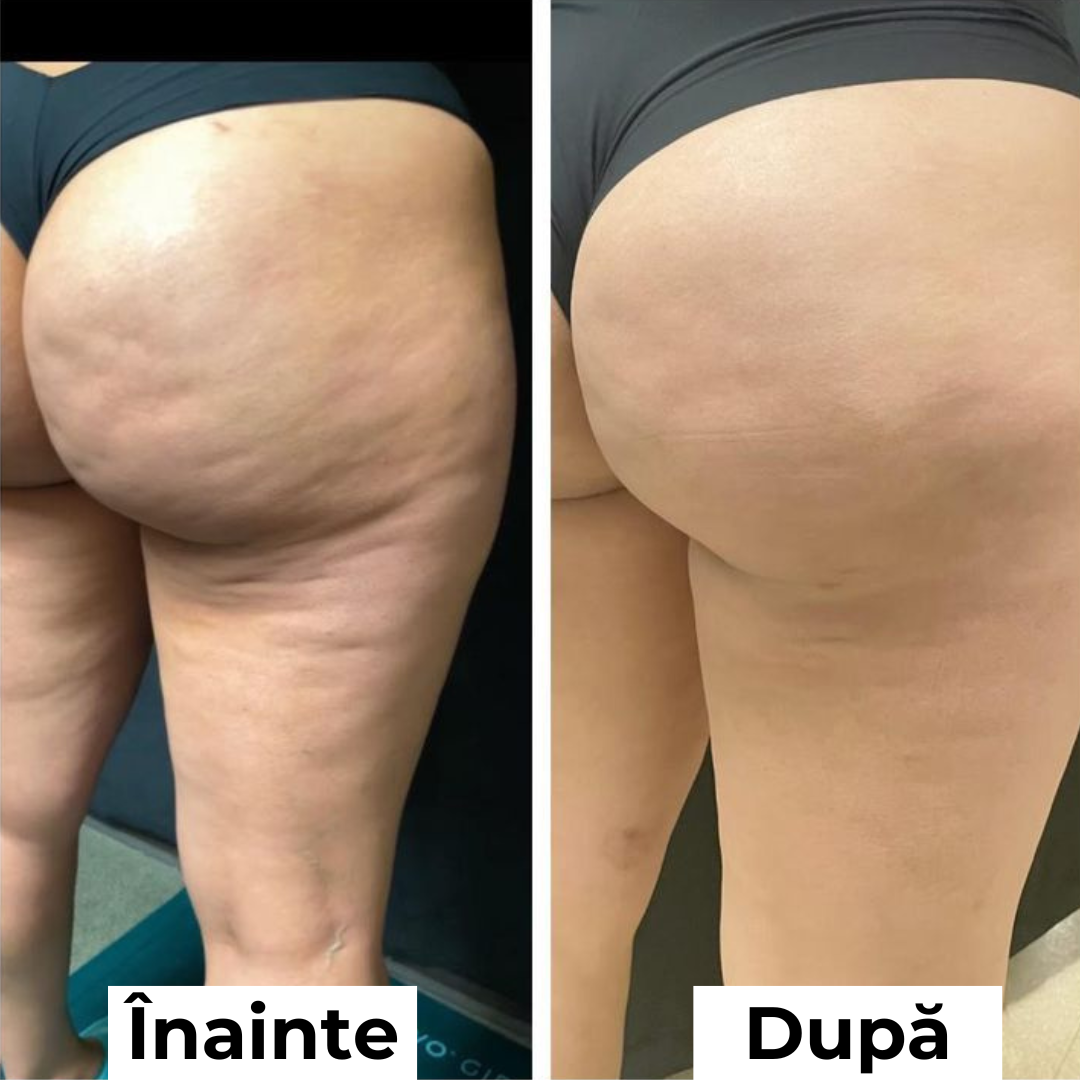 Cremă Pentru Fermitatea Coapselor